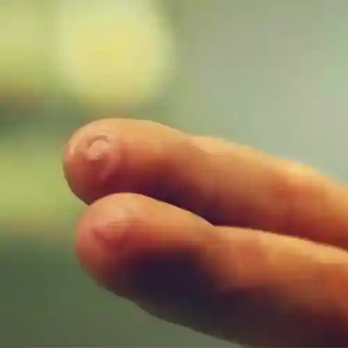 تاول زدن انگشت